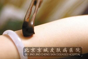 怎么防止皮肤瘙痒症的发生