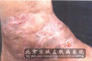 足菌肿的治疗方法是什么