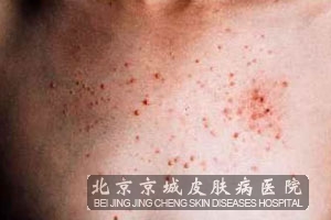 毛囊炎怎样处理