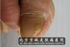 甲癣如何做出诊断