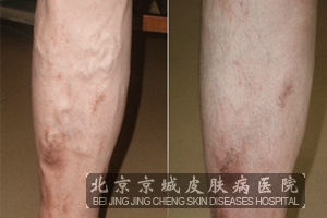 淤滞性皮炎中医怎么治疗