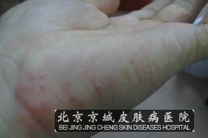 得了汗疱疹应该如何护理