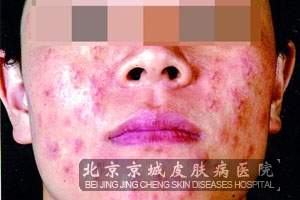 皮肤出现过敏需要注意什么