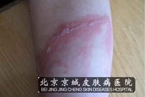 治疗皮炎期间怎么护理