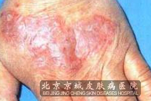 得了湿疹有哪些治疗方法