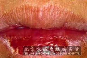 光化性唇炎有哪些鉴别诊断