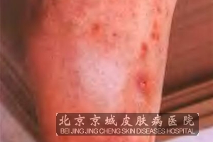 引起湿疹发病的原因都有哪些
