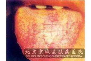 裂沟舌是什么原因引起的
