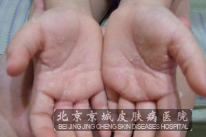 得了汗疱疹有哪些治疗方法