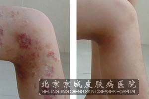 夏季得皮炎的原因是什么