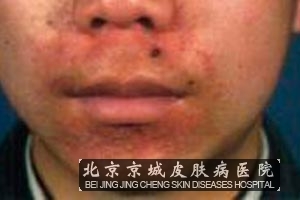 怎样防止神经性皮炎