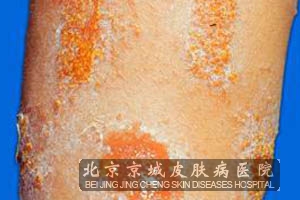自身敏感性皮炎需要做哪些检查