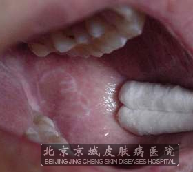 癬 扁平 苔 口腔扁平苔蘚的症狀和治療方法