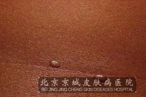 疣的治疗方法有哪些_疣_北京京城皮肤病医院(北京医保