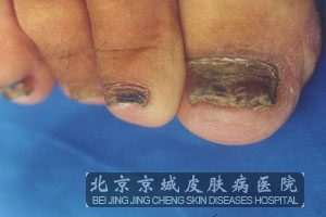 导致灰指甲的病因是什么