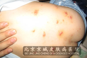 得了水痘要如何护理