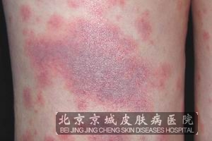 该怎样缓解药疹的特殊症状呢