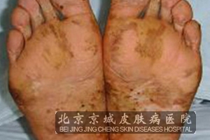 中医怎样治疗脚气
