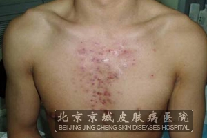 糠秕孢子菌性毛囊炎有哪些症状表现