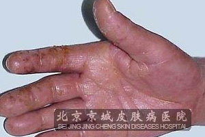 如何预防接触性皮炎发病