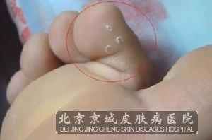 脚上长水泡是不是脚气