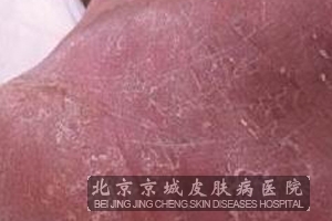 怎样治疗脚气才好