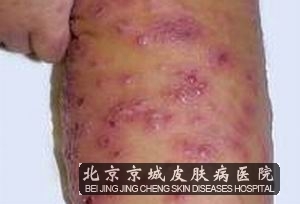 得了湿疹有什么治疗方法