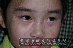 麻疹患儿的护理措施都有哪些