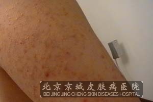 糠秕孢子菌性毛囊炎需要做什么检查
