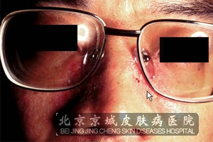治疗接触性皮炎有什么方法