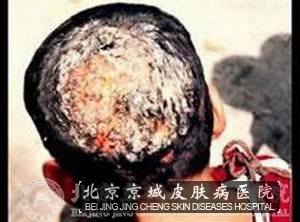 头癣需要与哪些疾病相鉴别