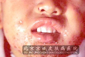 脓疱疮的检查有哪些