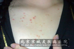 糠秕孢子菌毛囊炎有哪些症状表现