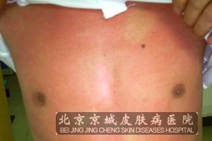 接触性皮炎怎么护理