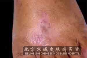 得了接触性皮炎如何治疗