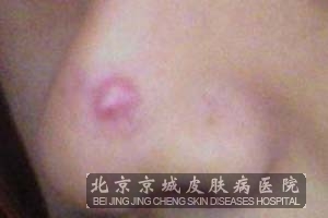 治疗毛囊炎有哪些方法