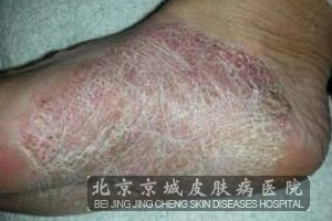 脚气会引起哪些并发症