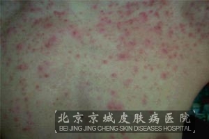 糠秕孢子菌性毛囊炎有什么症状特征