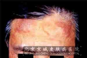 容易引发接触性皮炎的物质有哪些