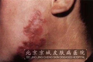 原发性皮肤结核综合征的鉴别诊断