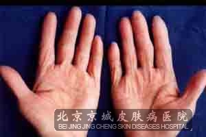 汗疱疹有什么鉴别诊断