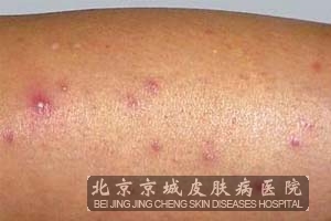 如何预防毛囊炎的发生