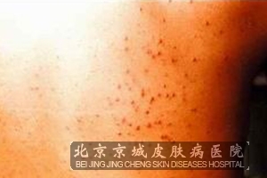 糠秕孢子菌毛囊炎有什么表现