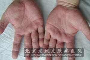 汗疱疹都有哪些症状