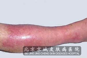 导致丹毒复发的原因有哪些_丹毒_北京京城皮肤病医院