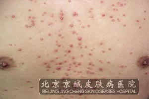 糠秕孢子菌毛囊炎有哪些表现呢