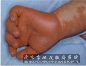 硬肿症患儿的主要症状