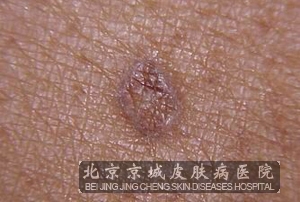 毛囊角化症临床的症状_毛囊角化_北京京城皮肤病医院