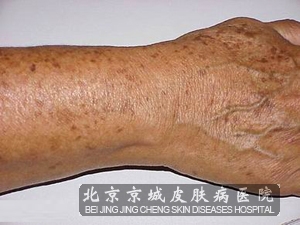 汗孔角化症的饮食护理