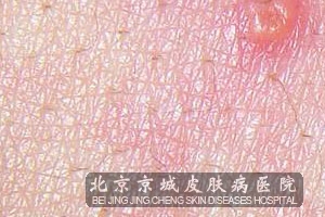 疱疹治疗的方法都有哪些